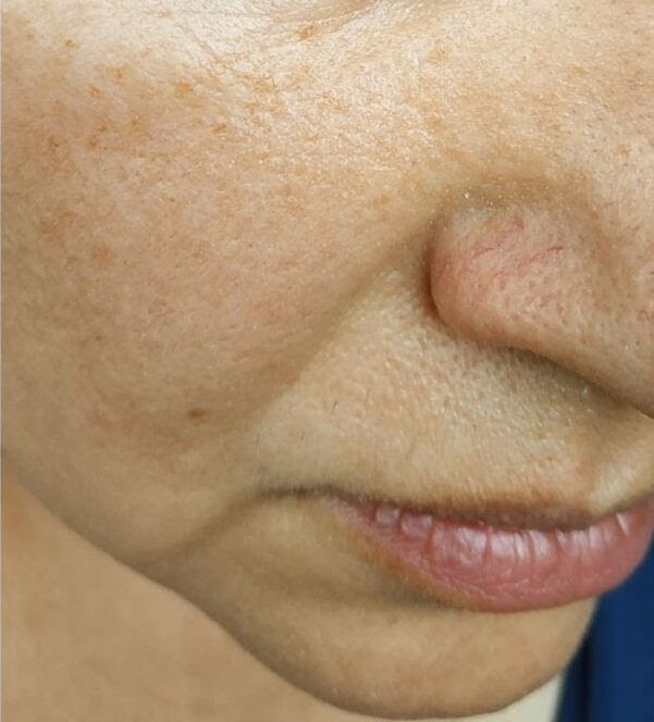 By the age of 40, nasolabial folds appeared